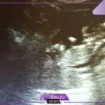 شكل كيس الجنين ونوعه بالصور في الشهر الثاني