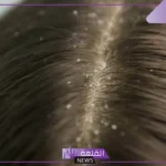 تفسير حلم إخراج القمل من الشعر في المنام