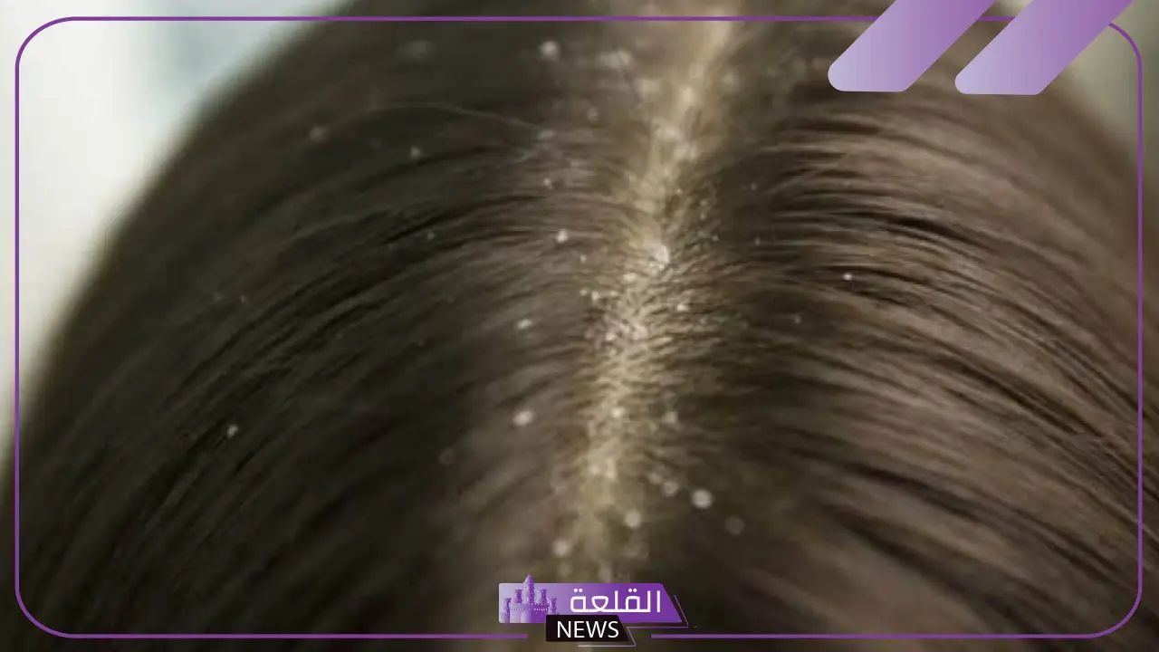 تفسير حلم إخراج القمل من الشعر في المنام