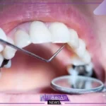 تفسير حلم تسوس الاسنان للعزباء والمتزوجة في المنام لابن سيرين