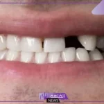 تفسير حلم سقوط الاسنان السفلى في المنام للرجل والمرأة لابن سيرين