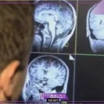 5.5 مليون حالة وفاة سنويًا.. خبيرة توضح 6 تغييرات في حياة الإنسان تحميه من السكتة الدماغية