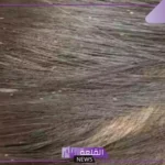 تفسير حلم القمل في الشعر في المنام للمتزوجة لابن سيرين