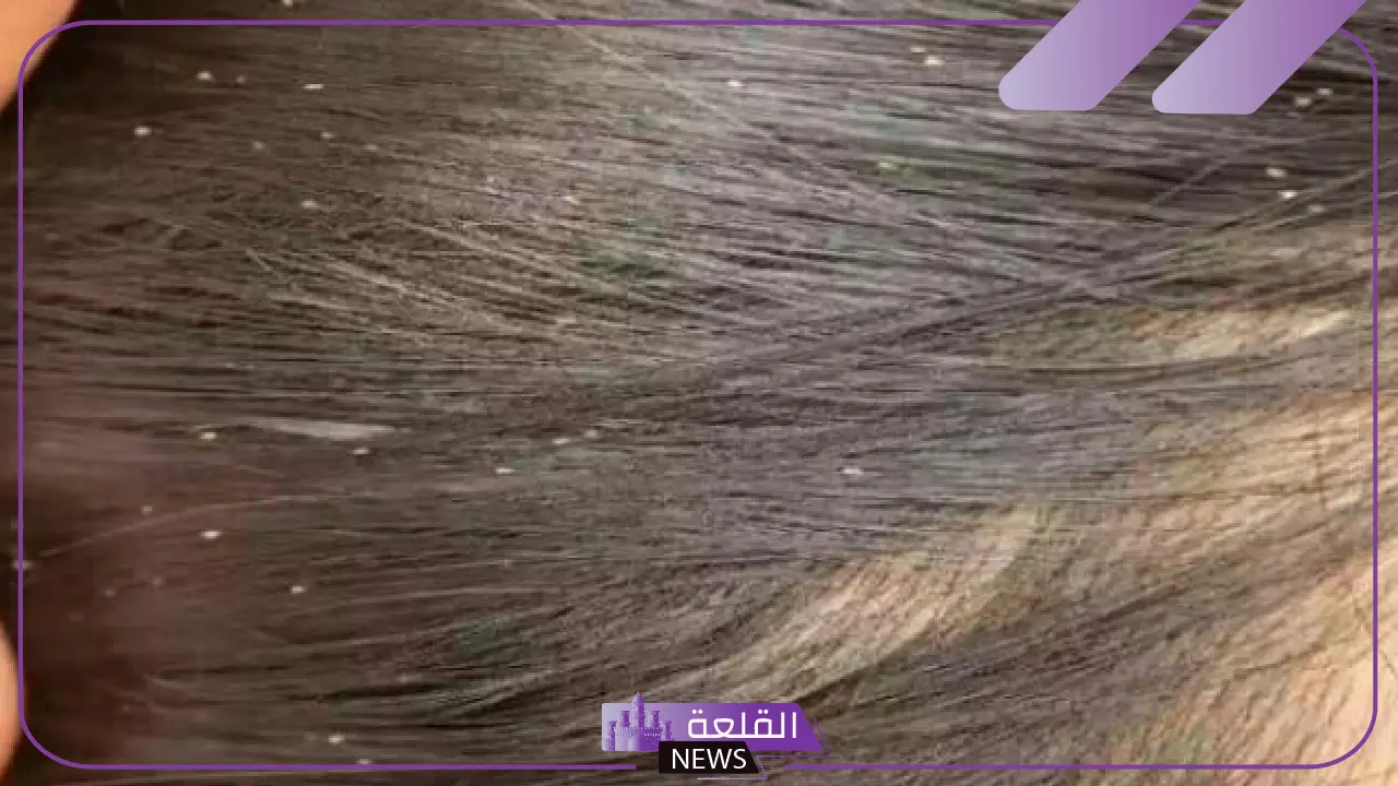 تفسير حلم القمل في الشعر في المنام للمتزوجة لابن سيرين