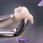 تفسير حلم خلع الضرس في المنام للمتزوجة والحامل لابن سيرين