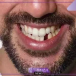 تفسير حلم سقوط سن واحد فقط في المنام للمراة والرجل لابن سيرين