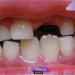 تفسير حلم سقوط السن الامامي في المنام للرجل لابن سيرين