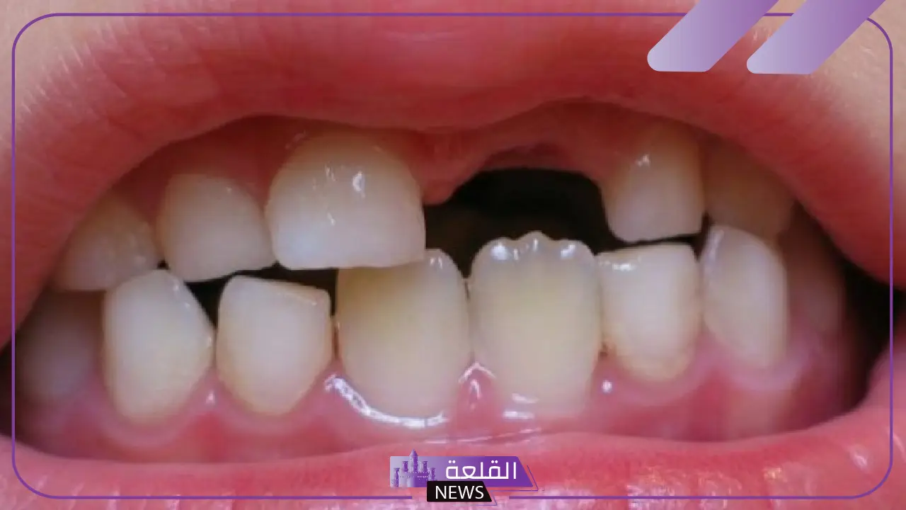 تفسير حلم سقوط السن الامامي في المنام للرجل لابن سيرين