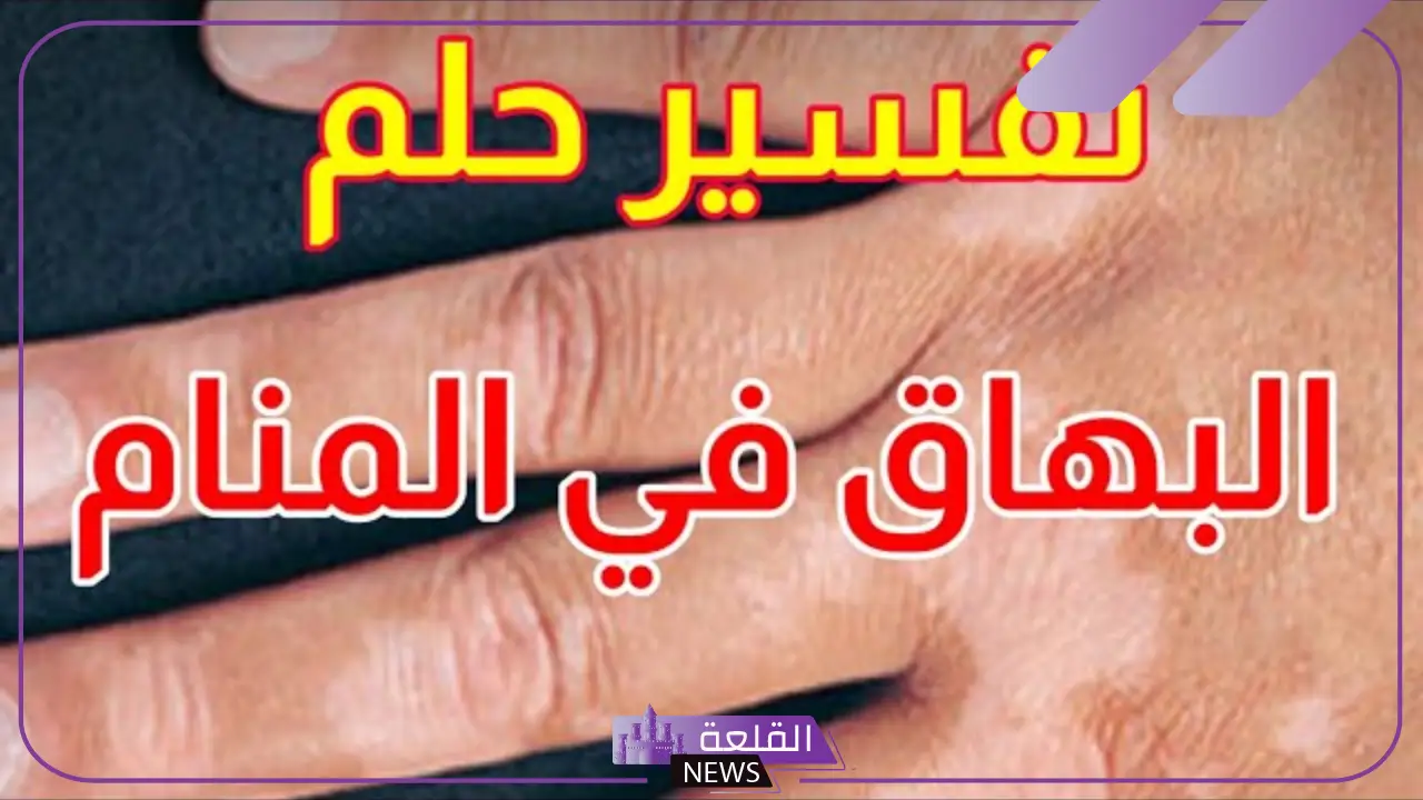تفسير حلم الإصابة بمرض البهاق في المنام للعزباء للعصيمي