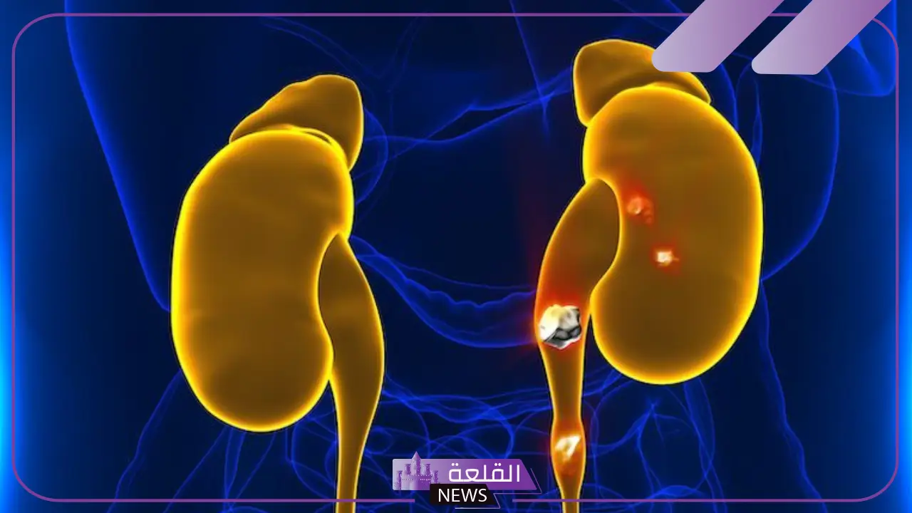 تمارين لانزال حصوة الحالب.. أعراض خروج حصوة الحالب تمارين لانزال حصوة الحالب.. أعراض خروج حصوة الحالب