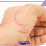 تفسير حلم الجرح في المنام للرجل والمرأة لابن سيرين
