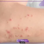 الحزام الناري والعلاقة الزوجية.. هل الحزام الناري معدي؟