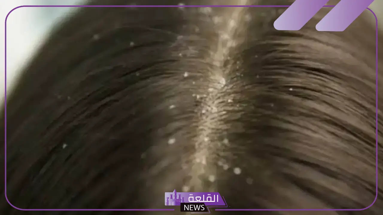 تفسير حلم القمل في شعر بنتي للمتزوجة في المنام لابن سيرين 5 تفسير حلم القمل في شعر ابنتي للنابلسي