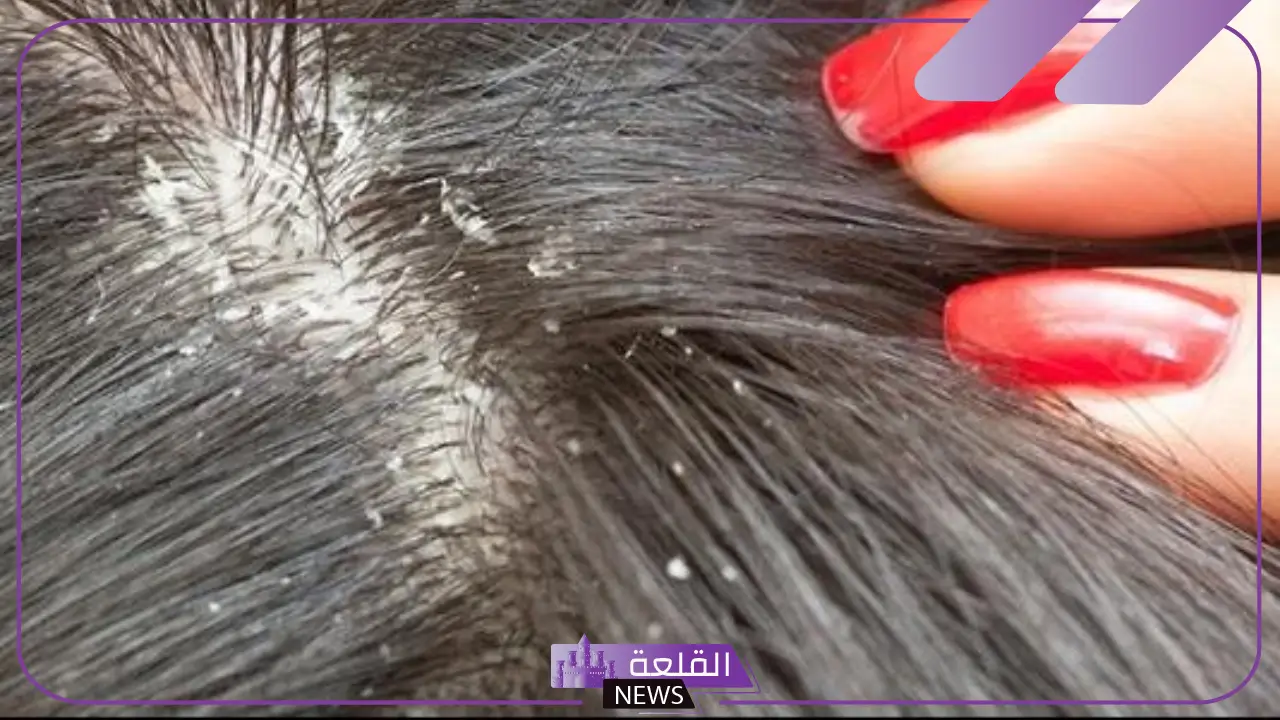 تفسير حلم رؤية القمل في المنام للمتزوجة والعزباء لابن سيرين 5 حلم رؤية القمل في المنام