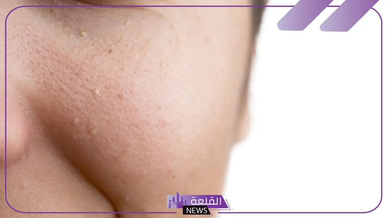 تفسير حلم الحبوب في الوجه للمرأة العزباء والمتزوجة في المنام لابن سيرين 5 دلالة حلم الحبوب في الوجه