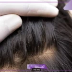 تفسير حلم رؤية القمل في المنام للمتزوجة والعزباء لابن سيرين