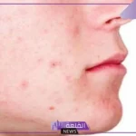تفسير رؤية حبوب في وجه شخص اعرفه للحامل والمتزوجة لابن سيرين
