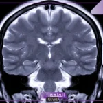 خطط العلاج المُخصصة للورم الأرومي الدبقي في المستشفيات الألمانية الرائدة مع Booking Health