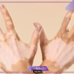 تفسير حلم الإصابة بمرض البهاق في المنام للمرأة العزباء