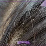 تفسير حلم القمل في الشعر في المنام للحامل والمتزوجة لابن سيرين