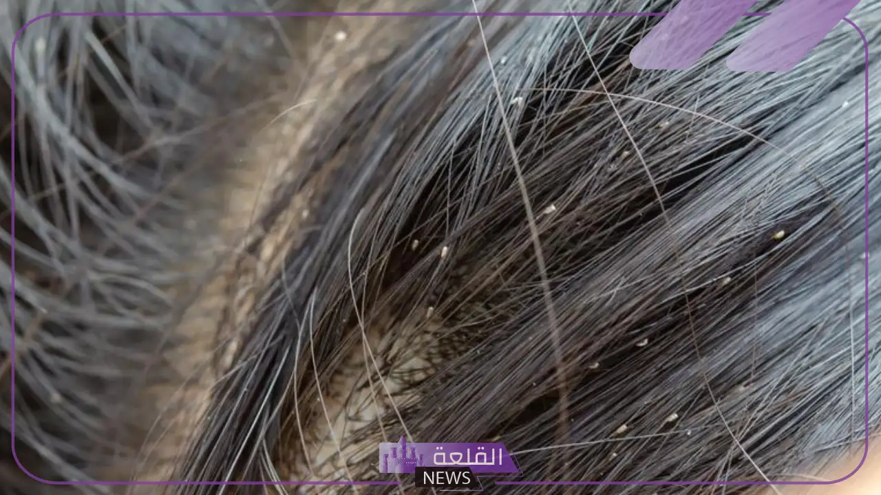 تفسير حلم القمل في الشعر في المنام للحامل والمتزوجة لابن سيرين