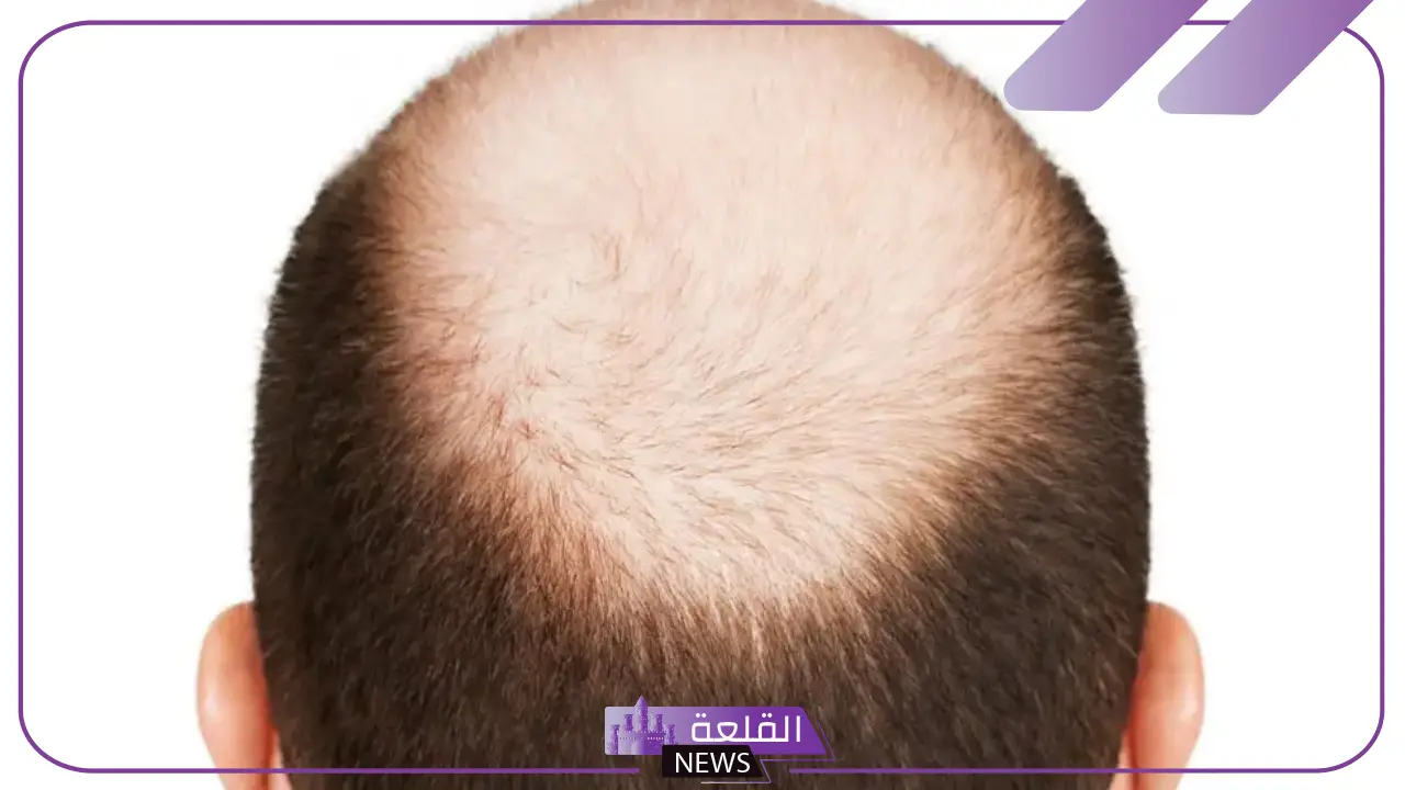 تفسير رؤية الصلع في المنام للأعزب والمتزوج في مقدمة الرأس 5 تفسير حلم الصلع للرجل المتزوج