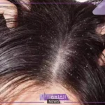 تفسير رؤية القمل في المنام لابن سيرين للعزباء والمتزوجة