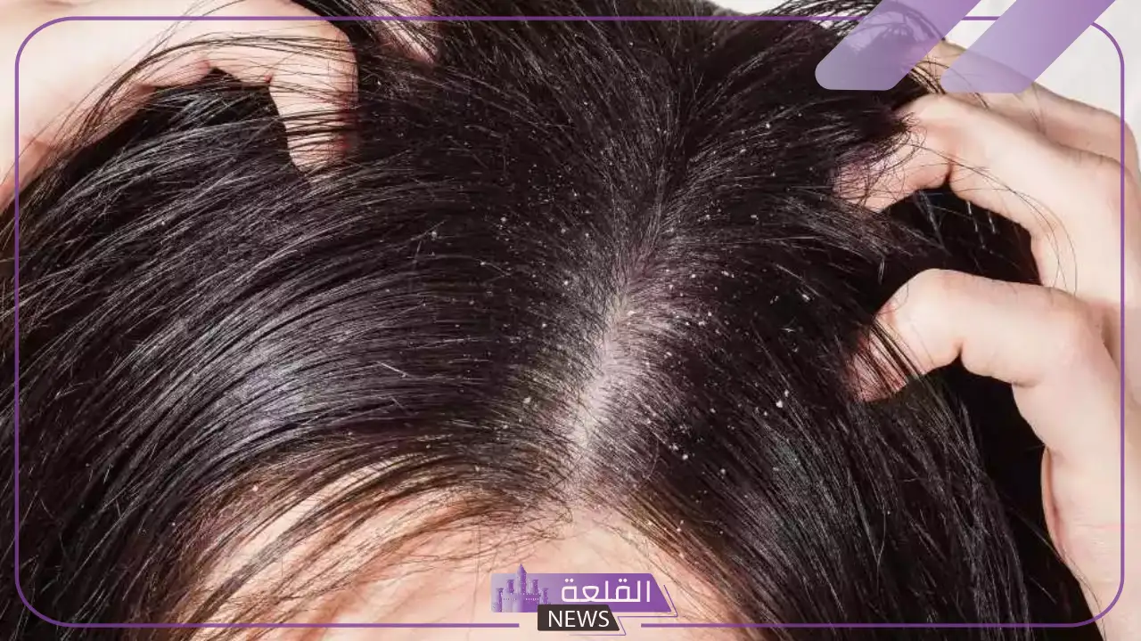 تفسير رؤية القمل في المنام لابن سيرين للعزباء والمتزوجة