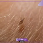 تفسير رؤية القمل في المنام للعزباء والمتزوجة في الشعر وقتله
