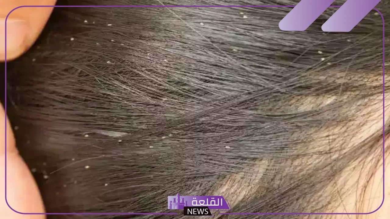 حلمت ان شعري فيه قمل في المنام للرجل والمرأة العزباء والمتزوجة حلمت ان شعري فيه قمل في المنام للرجل والمرأة العزباء والمتزوجة