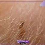 حلمت ان شعري فيه قمل في المنام للرجل والمرأة العزباء والمتزوجة