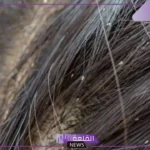 تفسير رؤية الحلم بالقمل في الشعر للمرأة في المنام عند ابن سيرين
