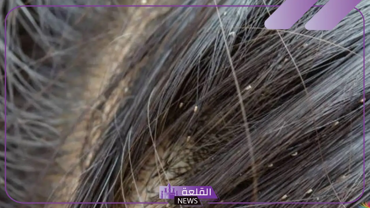 تفسير رؤية الحلم بالقمل في الشعر للمرأة في المنام عند ابن سيرين