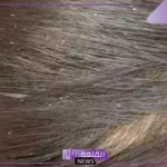 تفسير القمل في الشعر في المنام للعزباء للعالم ابن سيرين