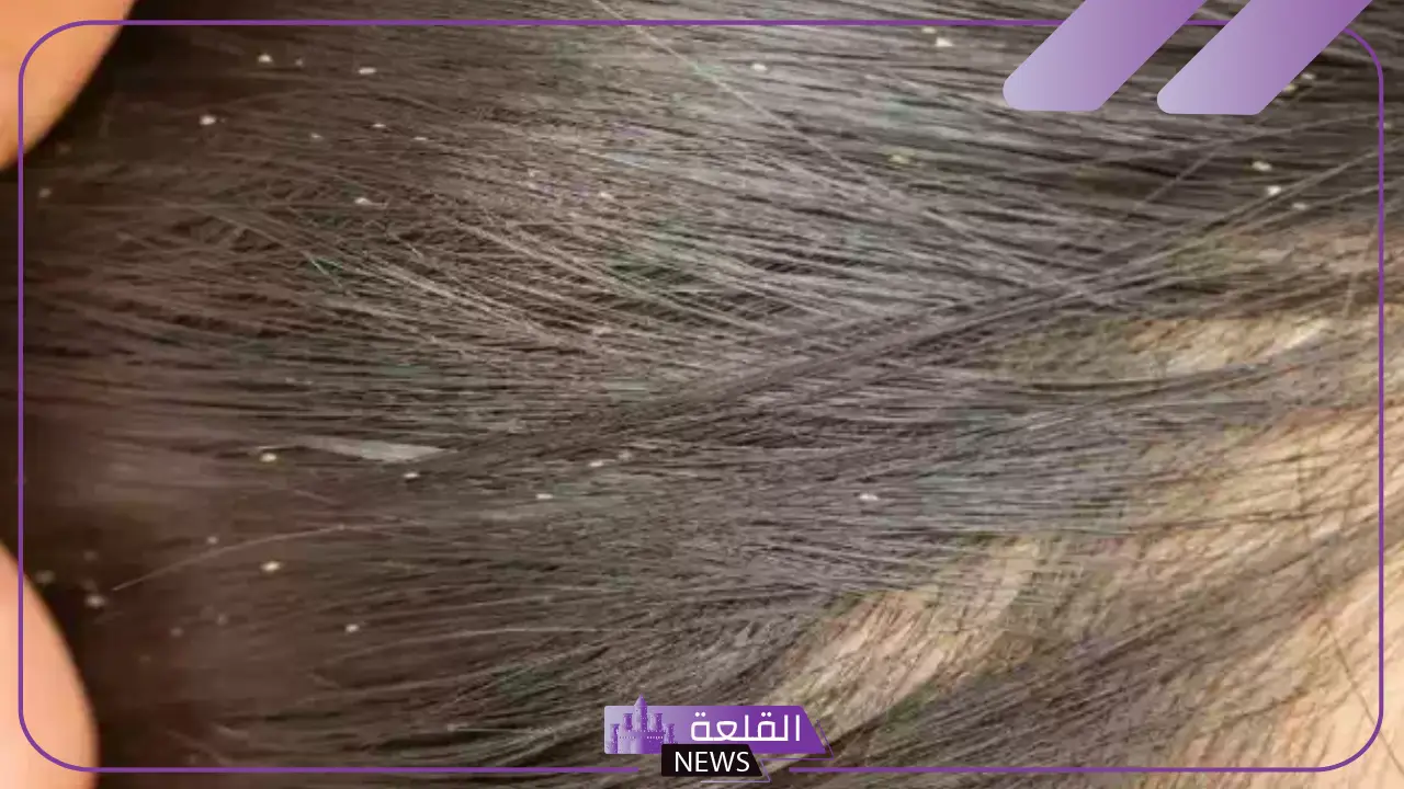تفسير القمل في الشعر في المنام للعزباء للعالم ابن سيرين