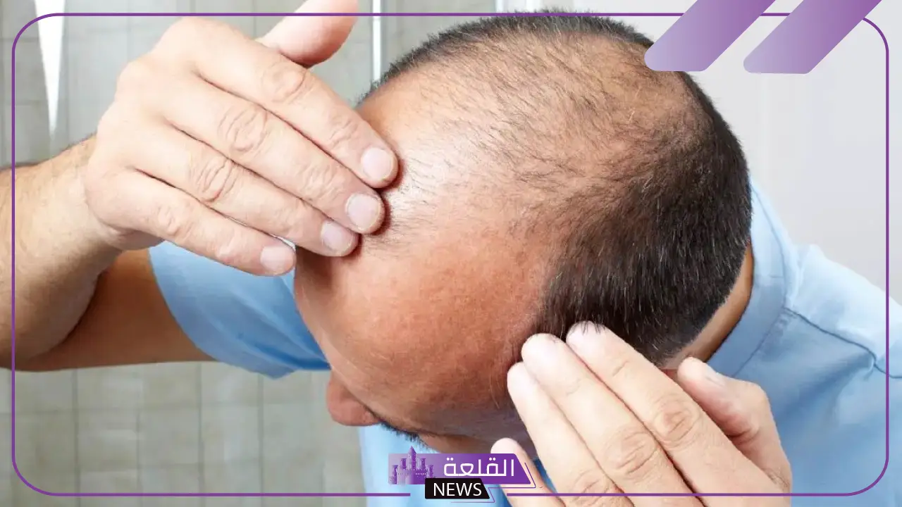 تفسير حلم الصلع للرجل المتزوج في المنام في جزء من الرأس تفسير حلم الصلع للرجل المتزوج في المنام في جزء من الرأس