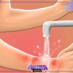 تفسير حلم الحرق في الجسم للعزباء والمرأة المتزوجة والحامل في المنام