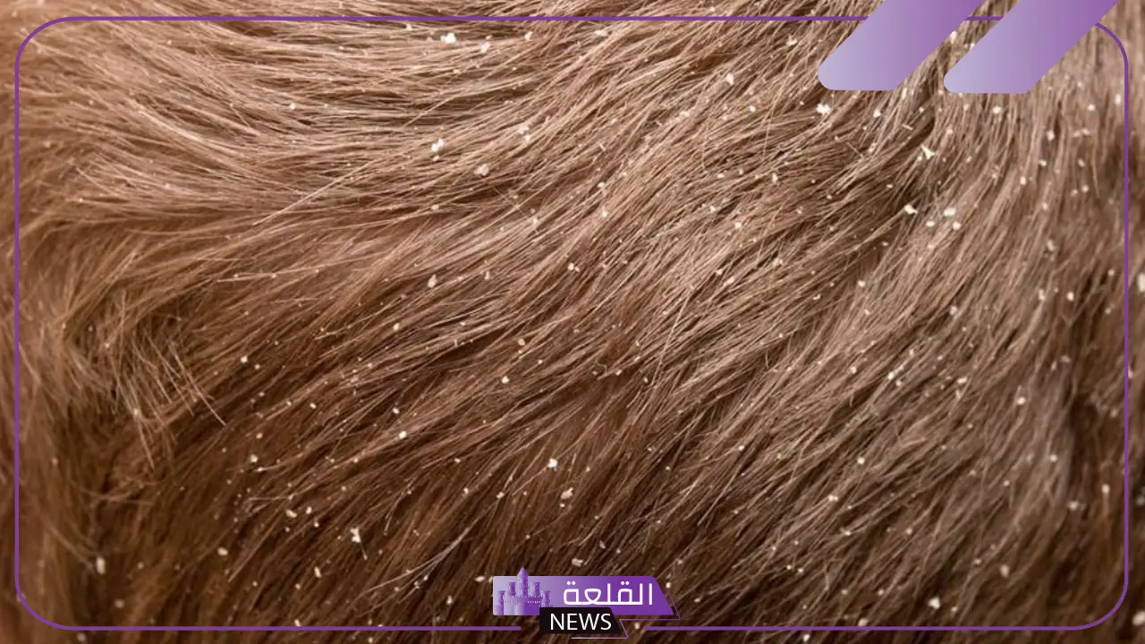 تفسير حلم رؤية القمل الابيض في المنام وقتله للمرأة المتزوجة