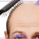 تفسير حلم الصلع للرجل المتزوج في المنام في جزء من الرأس