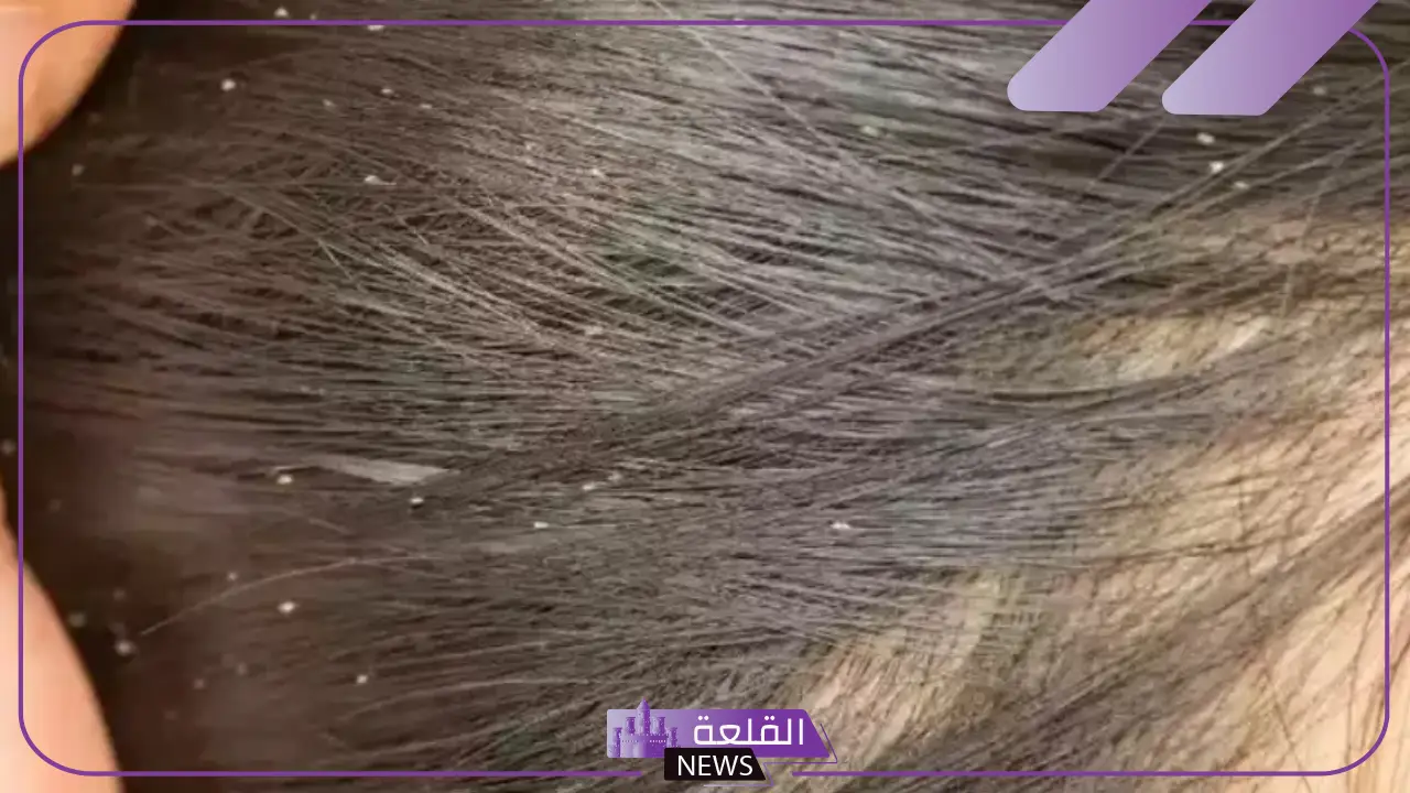 تفسير الحلم بالقمل في المنام للمتزوجة ورمز رؤيته لابن سيرين تفسير الحلم بالقمل في المنام للمتزوجة ورمز رؤيته لابن سيرين