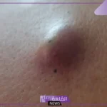 أسباب ظهور كيس دهني في البطن وأعراضه