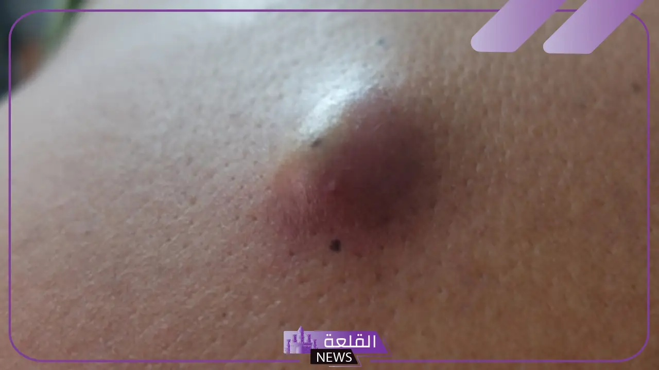 أسباب ظهور كيس دهني في البطن وأعراضه
